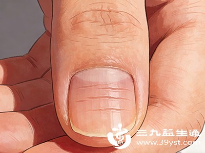 一些疾病也可能在指甲上留下“印记”,引发横纹凹陷。 一些疾病也可能在指甲上留下“印记”,引发横纹凹陷。