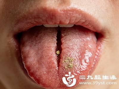 别慌 舌头中间有条深沟可能是这些情况在“捣鬼”