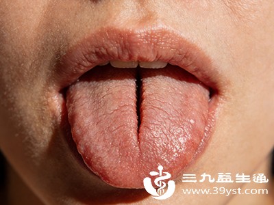 舌头中间有条深沟可能是这些情况在“捣鬼”