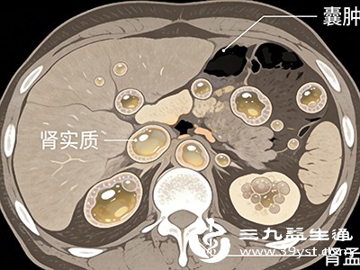有症状、大囊肿：对症处理