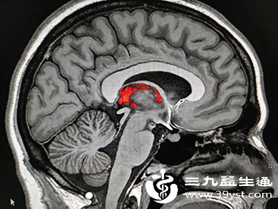 脑出血发生后，脑部血管破裂出血会压迫周围脑组织，导致脑组织缺血、缺氧