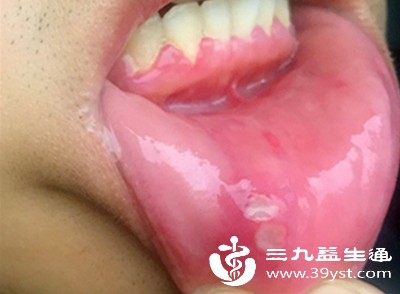 口腔溃疡 口腔溃疡