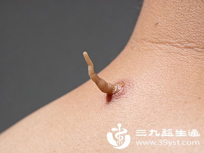 脖子上的“小疙瘩”咋去掉 不同类型有妙招 别瞎折腾