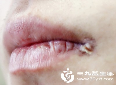 嘴唇裂口流血说话都疼 竟是缺维生素惹的祸 简单3招轻松拥有水润双唇