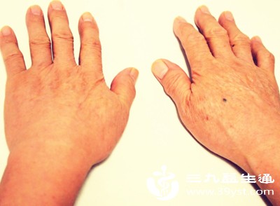 手指肿胀、疼痛、僵硬