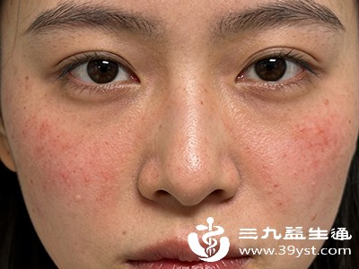一到换季脸就过敏 掌握几招敏感肌也能稳稳的