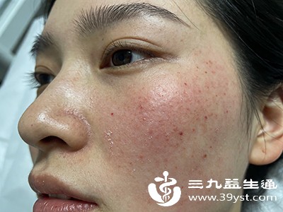 过敏康复后，需对护肤品、化妆品进行“断舍离”，逐一排查并标记可疑产品