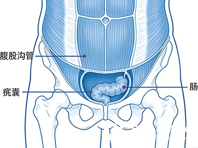 肚子里的组织从腹股沟的薄弱处“鼓”出来，站着、咳嗽或用力时疼得明显，躺下去可能就好了