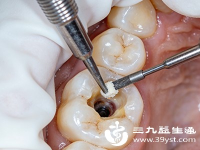 补牙或根管治疗后1-2天内，避免用患牙咀嚼食物，以防填充材料脱落或牙齿受力损伤
