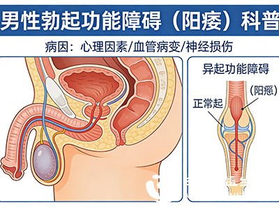 部分患者在独处时能出现一定勃起,但在与伴侣的性生活中完全无法勃起,这与心理压力、对表现的过度关注密切相关 部分患者在独处时能出现一定勃起,但在与伴侣的性生活中完全无法勃起,这与心理压力、对表现的过度关注密切相关