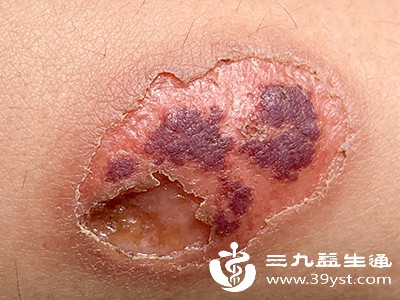 皮肤黏膜的慢性溃疡，如压疮、下肢溃疡等，长期不愈合会成为病原体滋生的温床，细菌可不断侵入血液循环，引发败血症