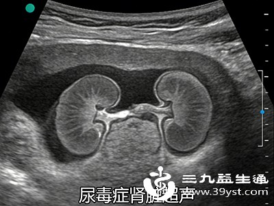 尿常规与肾脏超声 尿常规与肾脏超声