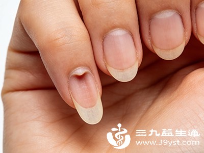 缺铁会导致指甲变薄、易碎，甚至出现“匙状甲”（指甲中央凹陷，边缘翘起，类似汤匙），这是缺铁性贫血的典型表现之一