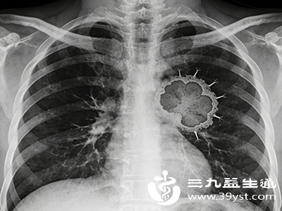 对于肺部的肿瘤，胸片可发现肺部的肿块影