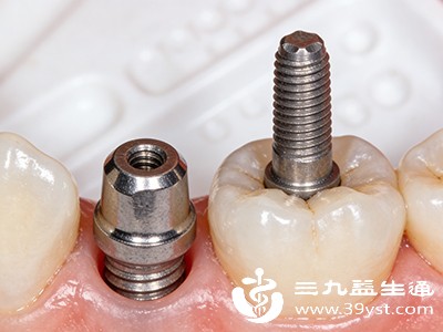 想种牙先看这篇 优点多但手术有风险费用周期揭秘 别花冤枉钱