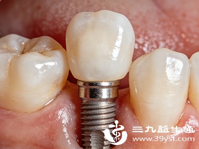 种牙的牙冠采用陶瓷材料，颜色、形状可根据邻牙定制，外观与天然牙高度相似，能自然融入牙齿排列，改善面部美观