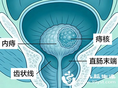 得了内痔别指望自愈 轻度可能缓解 重度得靠治疗