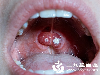 扁桃体炎 扁桃体炎