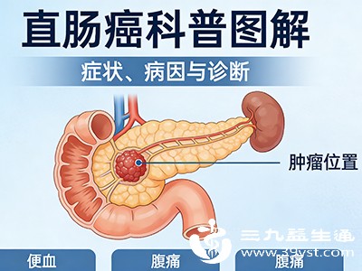 结直肠癌的预后与发现时间密切相关，早期治疗5年生存率可达90%以上
