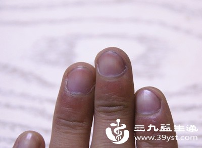 甲真菌感染(灰指甲) 甲真菌感染(灰指甲)