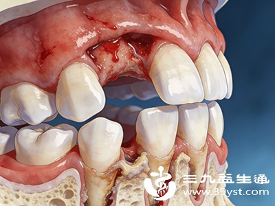 牙龈炎、牙周炎患者的牙龈红肿出血，牙周袋内堆积的牙菌斑和牙结石会分解产生硫化物，引发口苦
