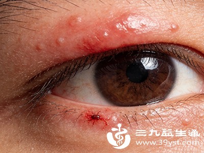 告别眼周蚊咬肿胀 简单有效安全不刺激