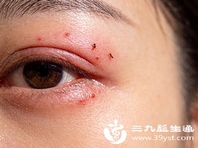 若肿胀部位出现脓性分泌物、红肿加剧、疼痛明显，可能已继发感染，需及时就医