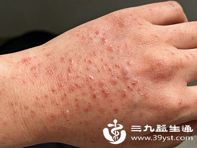 对小麦过敏者需避免食用，以免引发皮疹、腹泻等过敏反应