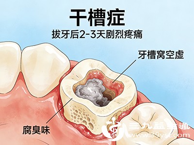 干槽症前兆 拔牙后需警惕的危险信号