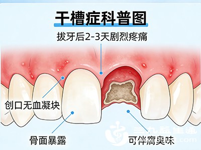拔牙过程复杂、创伤较大（如阻生智齿拔除需切开牙龈、去骨），会延长创口愈合时间，提高干槽症概率