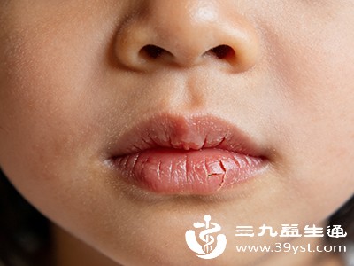 孩子嘴唇总干裂可能是这几个原因 对应办法家长快收好