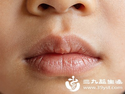 孩子发烧时，身体水分消耗增加，若未及时补充，会导致唇部干燥开裂