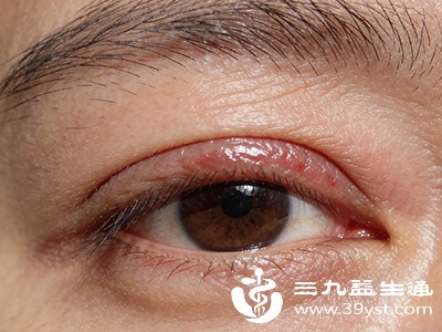 上眼皮短时间内肿胀严重,影响睁眼,伴随剧烈疼痛、视力模糊,可能是眼眶蜂窝织炎,需立即就医,避免感染扩散 上眼皮短时间内肿胀严重,影响睁眼,伴随剧烈疼痛、视力模糊,可能是眼眶蜂窝织炎,需立即就医,避免感染扩散