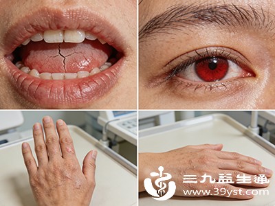 干燥综合征需要长期治疗,患者能否严格遵循医嘱用药、定期复查,对治疗效果影响显著 干燥综合征需要长期治疗,患者能否严格遵循医嘱用药、定期复查,对治疗效果影响显著