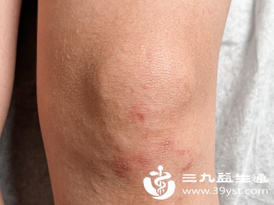 抽脂后，失去脂肪支撑的皮肤可能出现松弛下垂现象，尤其是年龄较大、皮肤弹性较差的人群，松弛会更为明显