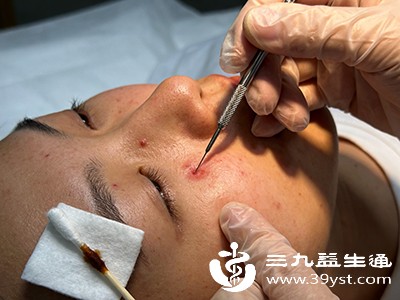 由专业医护人员用无菌器械清除暗疮内的脓液和堵塞物，能快速消除脓疱、结节，减少炎症扩散