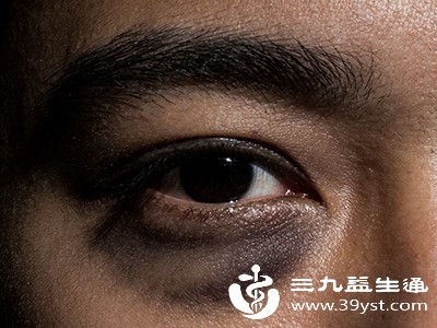 混合型黑眼圈则是以上两种或三种类型的结合,通常由多种因素共同作用导致,去除难度相对较大 混合型黑眼圈则是以上两种或三种类型的结合,通常由多种因素共同作用导致,去除难度相对较大