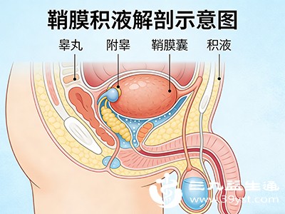 睾丸、附睾或精索部位的肿瘤会压迫或侵犯鞘膜组织，干扰鞘膜的正常生理功能，导致积液产生