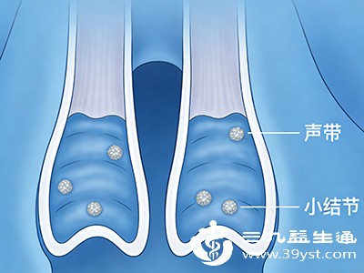 严格养护3个月后，声音嘶哑无改善，喉镜检查显示小结无明显缩小，需进行嗓音训练（在言语治疗师指导下练习正确发声方法）