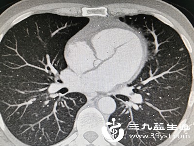 关注肺部纹理异常增多增粗可能与这些因素有关 值得重视
