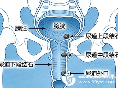 尿道结石可分为原发性和继发性两种，原发性尿道结石较少见，多为继发性，即由膀胱、肾脏的结石排出时滞留在尿道内形成