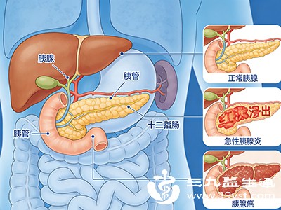 急性发作时，呕吐物多为黄绿色胆汁，而且呕吐之后疼痛并不会得到缓解