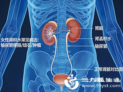 女性需注意 肾积水的这些潜在危害早点知道早点受益