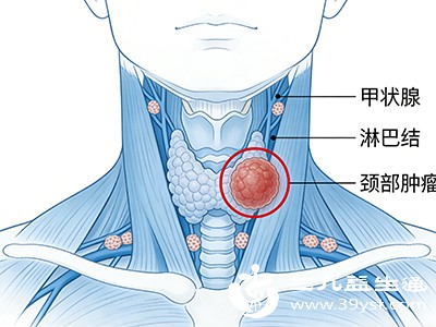 包括良性肿瘤（如脂肪瘤、神经鞘瘤）和恶性肿瘤（如淋巴瘤、甲状腺癌转移）