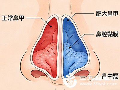 别等加重 鼻甲肥大自愈概率分析 这些情况必须就医