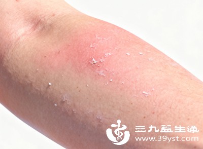 皮肤痒、起红疹就是皮炎？大错特错！这3种病最易混淆