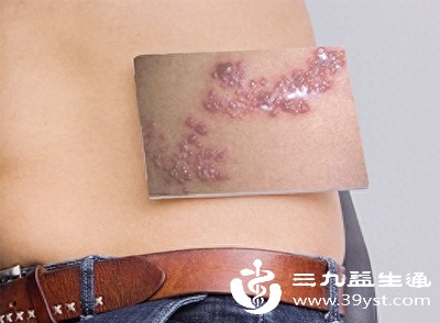 病毒性疱疹有传染性 不同类型传播风险各不同