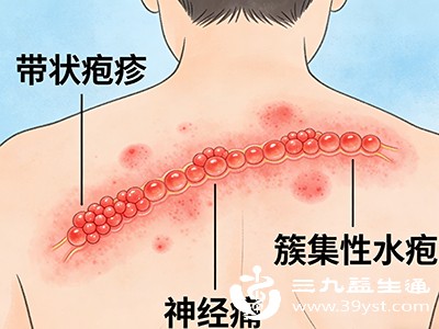 病毒性疱疹的传染真相 发作期风险高 日常防护要做好