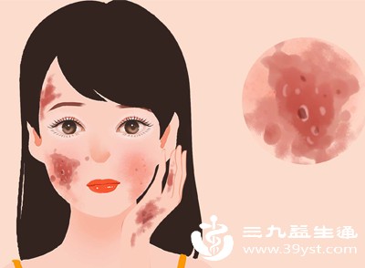 红斑狼疮早期有哪些信号 皮肤 关节 全身症状需警惕