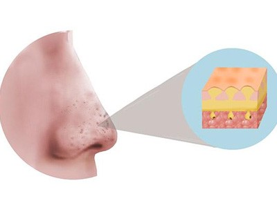 黑头vs白头到底差在哪 分清类型再改善 告别粗糙毛孔 素颜也能拥有光滑肌
